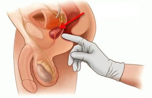 masáž prostaty pri prostatitíde